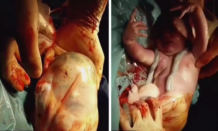 en-caul-c-section en-caul-c-section