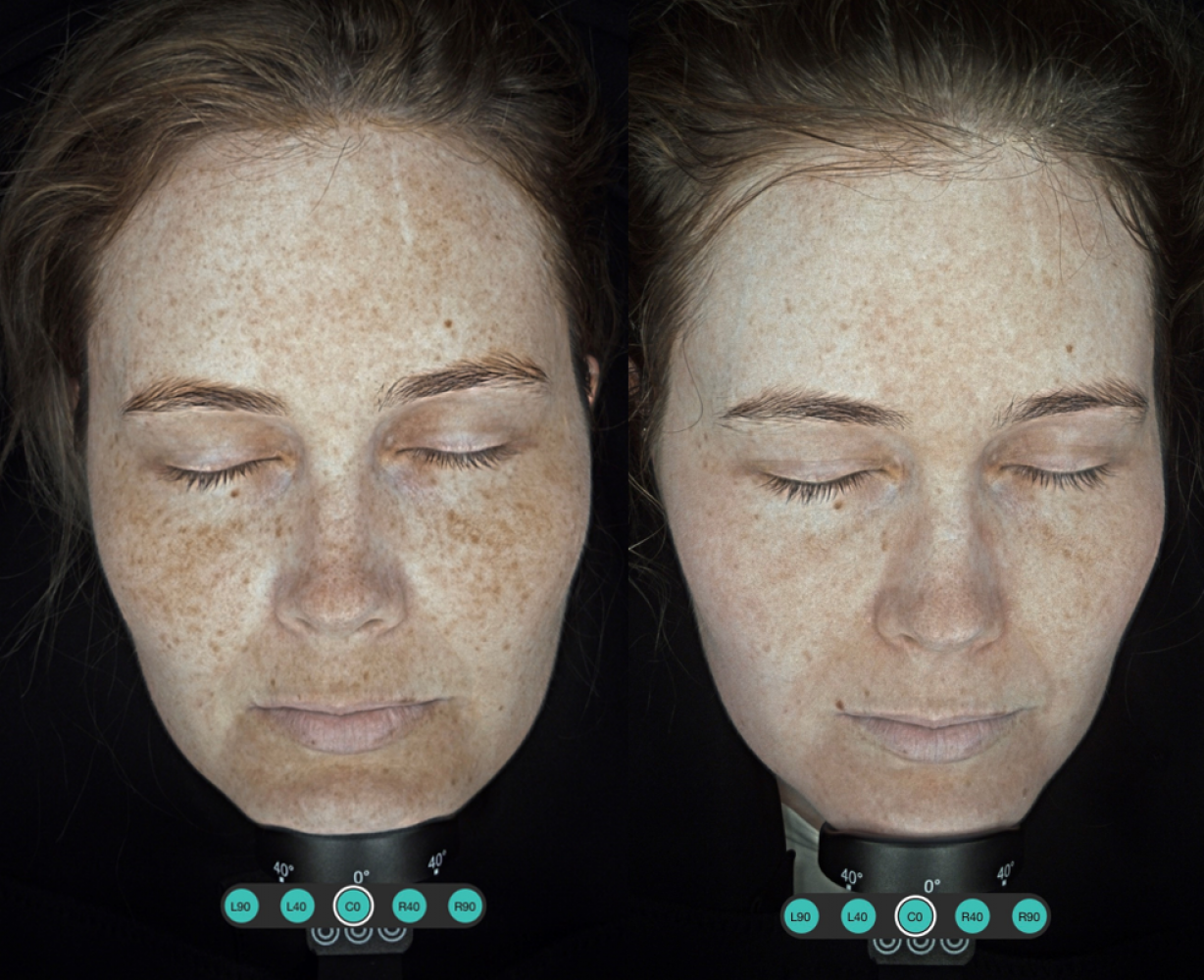 Jen's Cosmelan Peel Progress