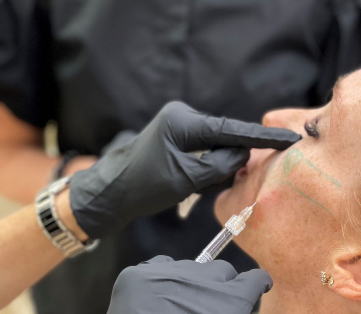 What to Expect After Cheek Filler