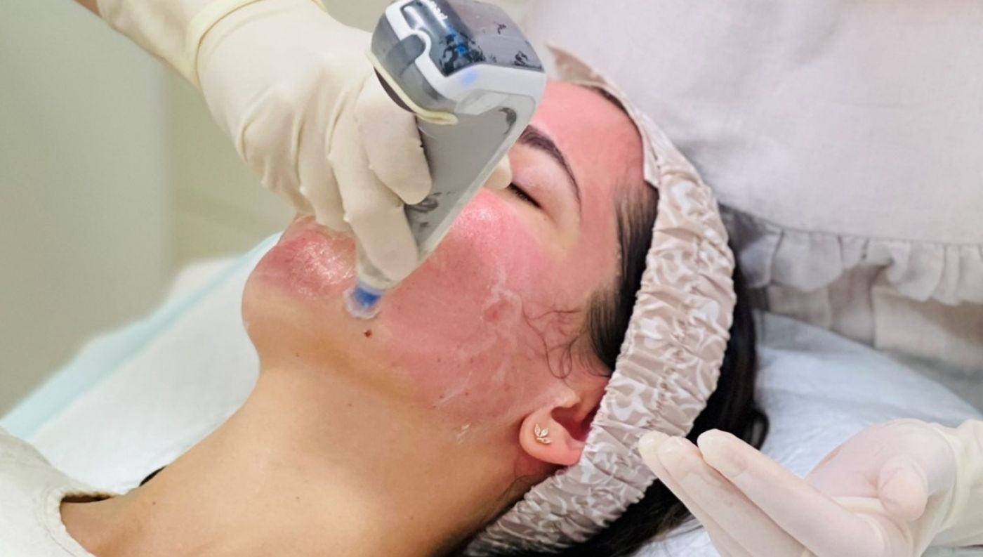 What Treatments Are Best For Acne?