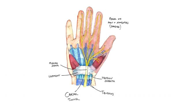 What Is Carpal Tunnel Syndrome and How Do You Treat It?
