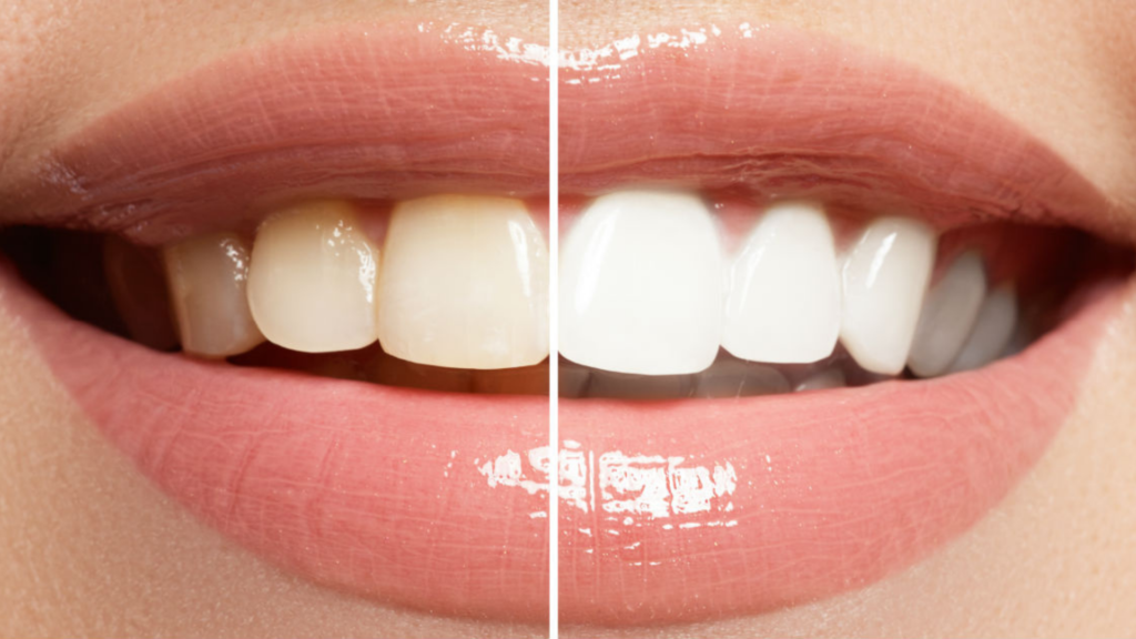 Top Tips To Ensure Your Teeth Stay White After A Whitening Treatment