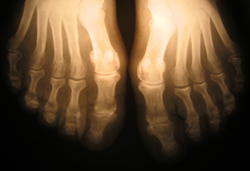 High-res bone scans without the radiation High-res bone scans without the radiation