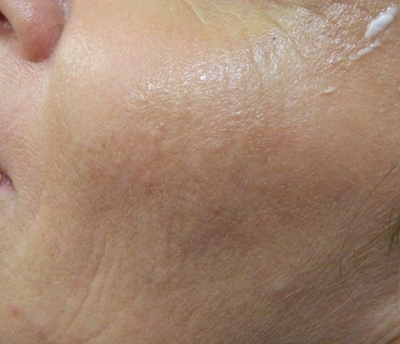 skin treatments hurstville parramatta skin treatments hurstville parramatta