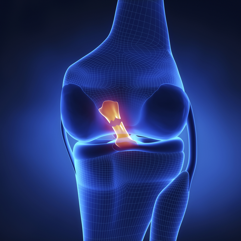 Identifying and Rehabbing an Anterior Cruciate Ligament Injury