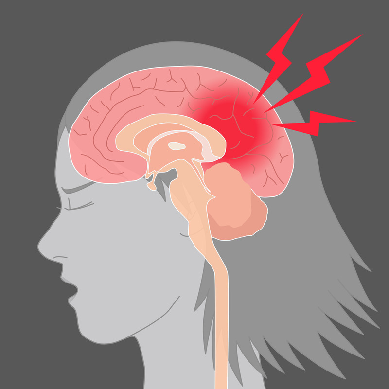 PostConcussion Syndrome Management for Adults