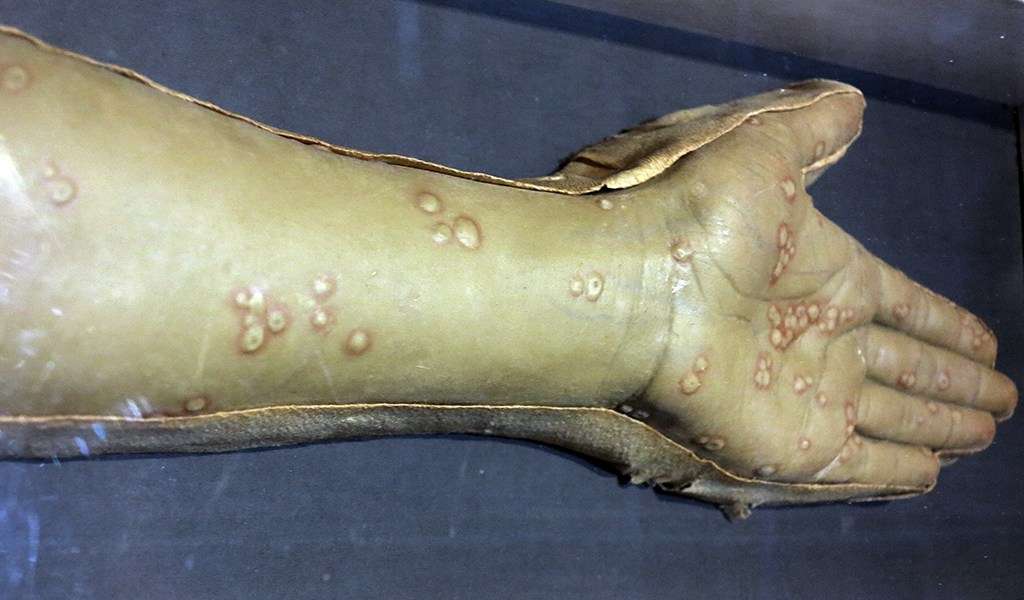 A monulage, or wax cast, of a smallpox infected arm.
