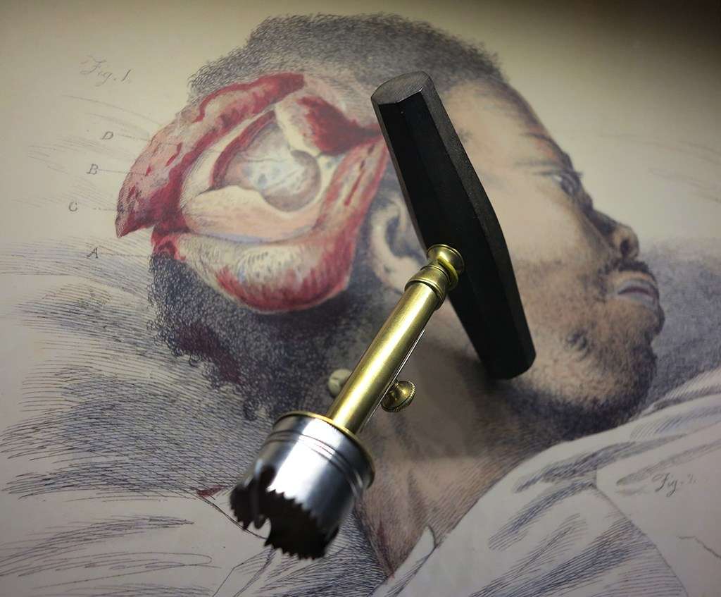 Trephines were used to remove pieces of the skull during surgery.