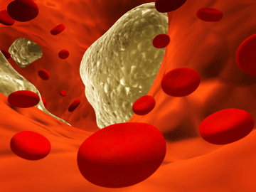 Cholesterol_cancer_web