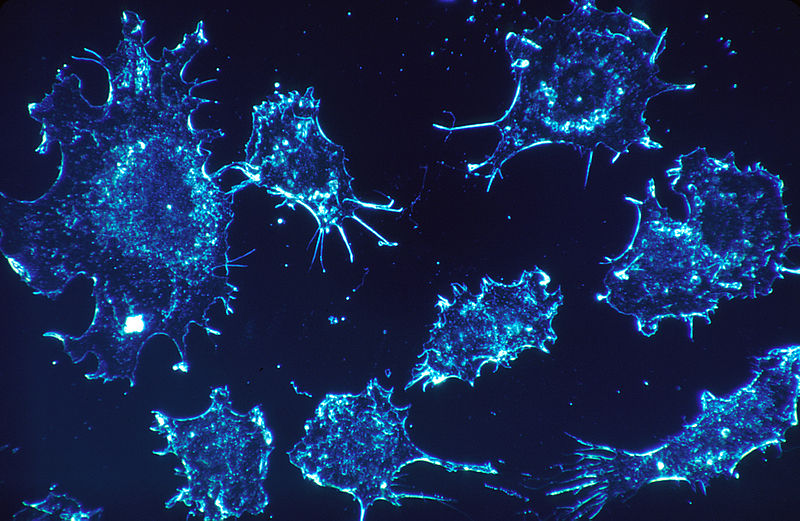 Cancer cells in culture. From the U.S. National Institute of Health.