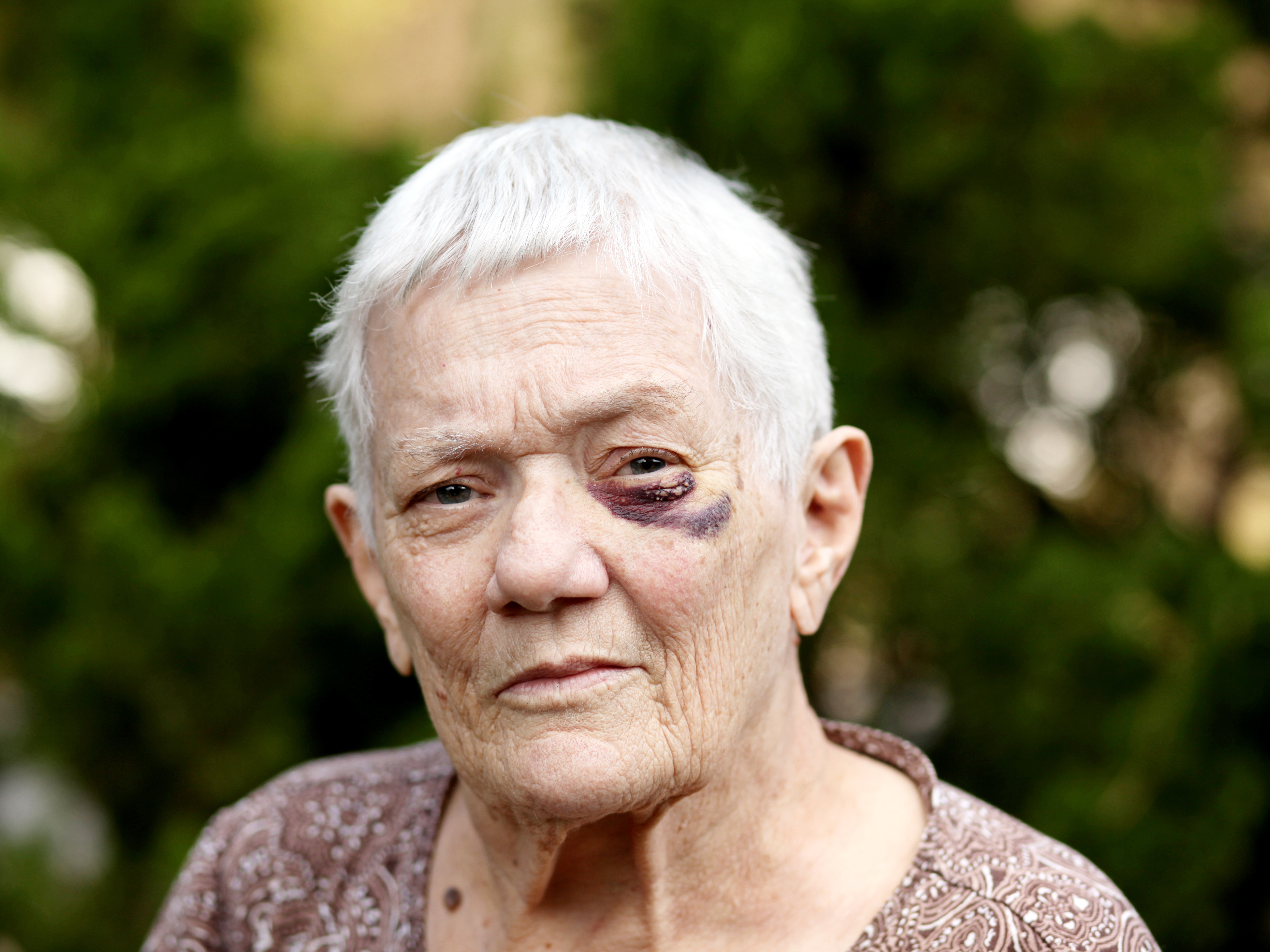 Older woman with a bruise on her face