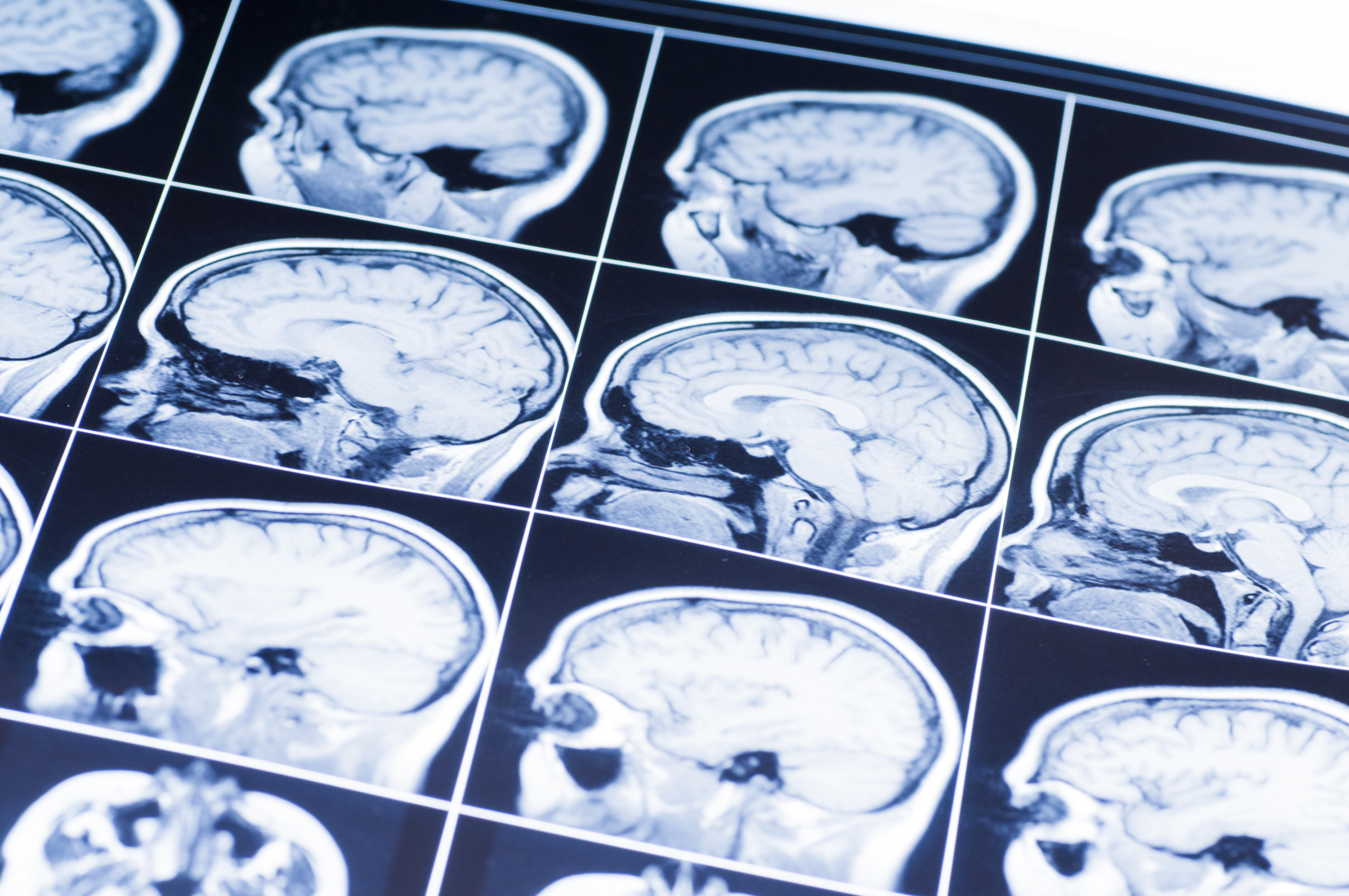 Acquired brain injury
