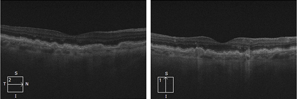Oct Rpe Disturbance mivision education