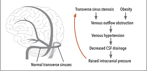 semaglutide iih Idiopathic Intracranial Hypertension and the Challenge of Weight Loss