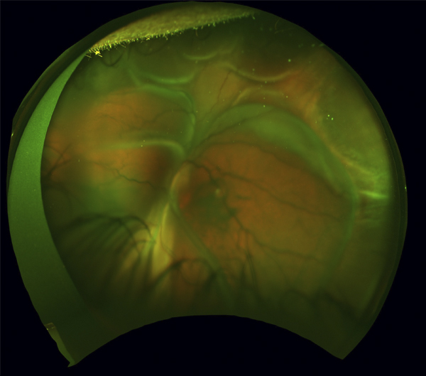 Phoenix Retina Camera Rop mivision education