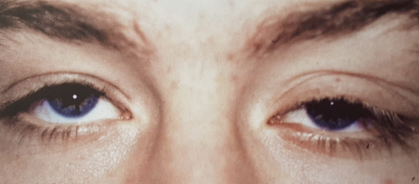blepharoplasty referring and managing the pre referral workup blepharoplasty referring and managing the pre referral workup