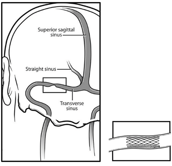 semaglutide iih Idiopathic Intracranial Hypertension and the Challenge of Weight Loss