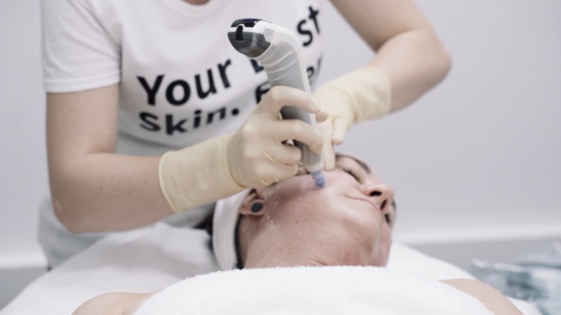 Skin Therapy | MIcroneedling 