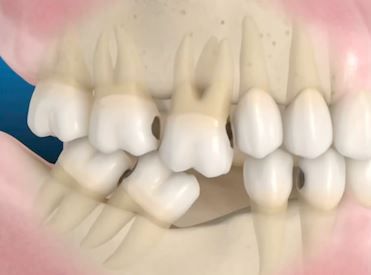 Why we need to replace missing teeth - By Dr Mark Wu