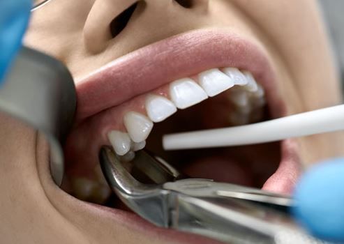 What can I eat after a tooth extraction? 
