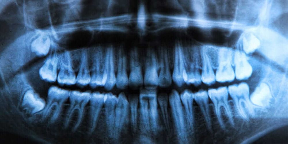 Wisdom Teeth - by Dr Miles Devlin