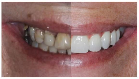 All on X Implant Treatment Process