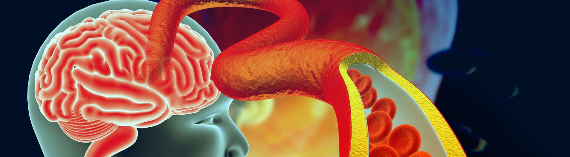 Cerebrovascular Disease
