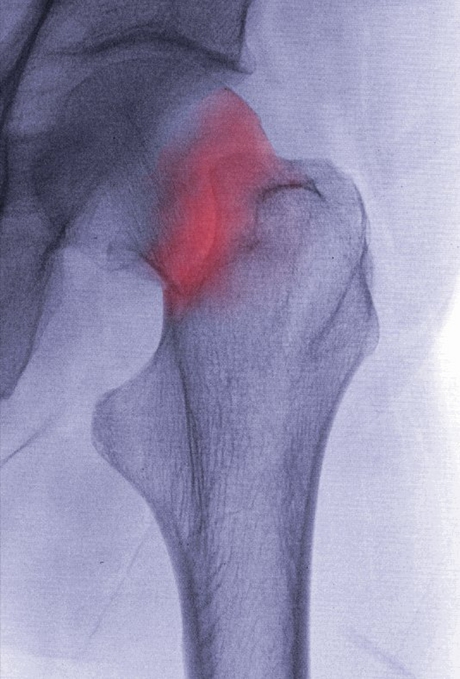 A gene associated with osteoporosis Osteoporotic hip fracture