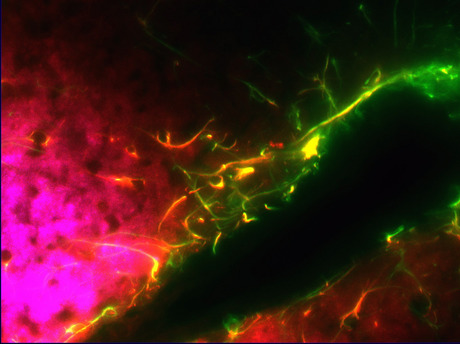 Chronic pain treatment with stem cells Immune cells