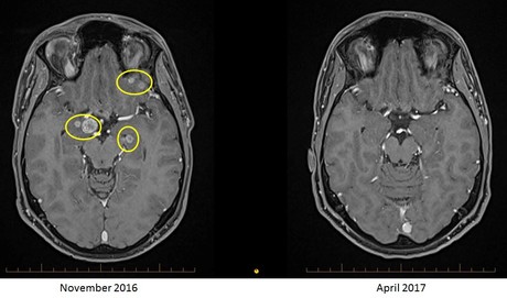 Australian researchers make melanoma breakthrough Leigh mri comparison