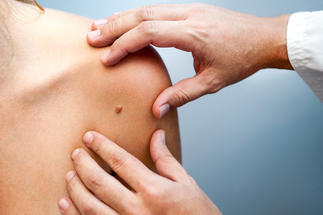 Get a 2nd — and 3rd — opinion: 1 in 6 melanoma diagnoses could be wrong Adobestock 72040252