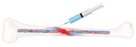 Aussie-invented bone 'glue' could halve patient recovery times Bone glue injection