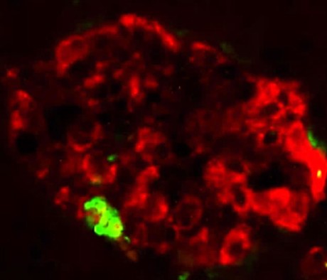 Misfolded pancreatic protein can induce symptoms of diabetes Protein