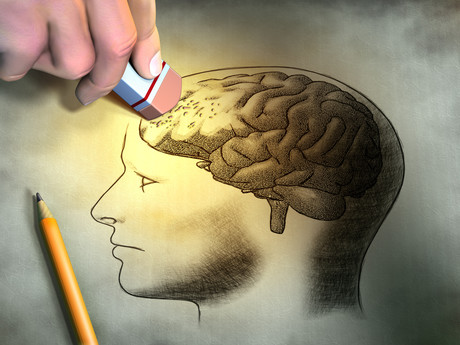 Inflammation in the brain may trigger Alzheimer's Adobestock 41168140