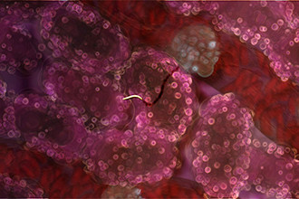 Malaria mystery solved Malaria infected liver