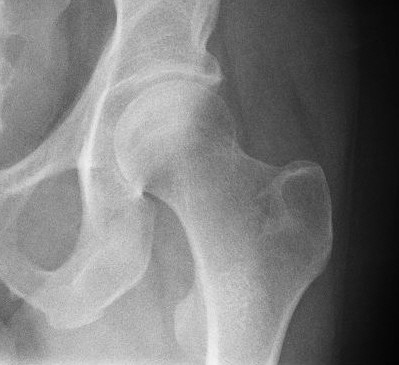 Honing healthcare with data analysis Hip pic
