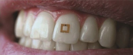 Track your eating habits with tooth-mounted sensors Image001