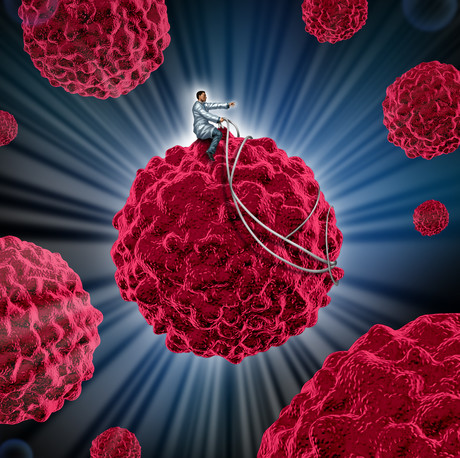 Lung cancer subtype responsive to immunotherapy Adobestock 55273026