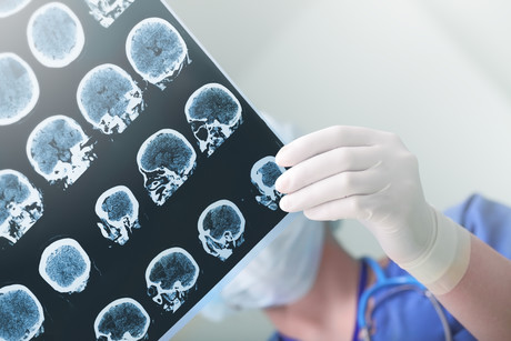 Epilepsy drugs in womb linked to poor school results Adobestock 94550028