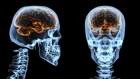 Traumatic brain injury increases risk of dementia Istock 000027998472xlarge