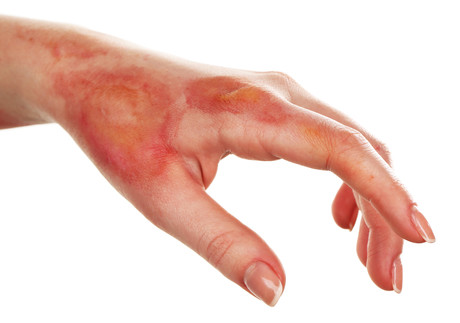 ReCell saves skin, reduces treatment costs for burn victims Adobestock 77427144