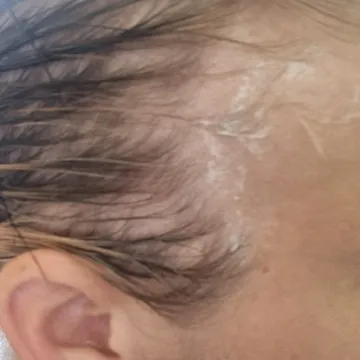 Hairloss, illness