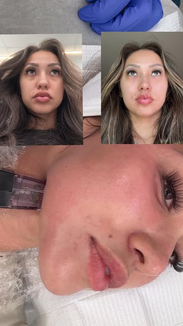 Non-Invasive Aesthetic Procedure: Before vs. After