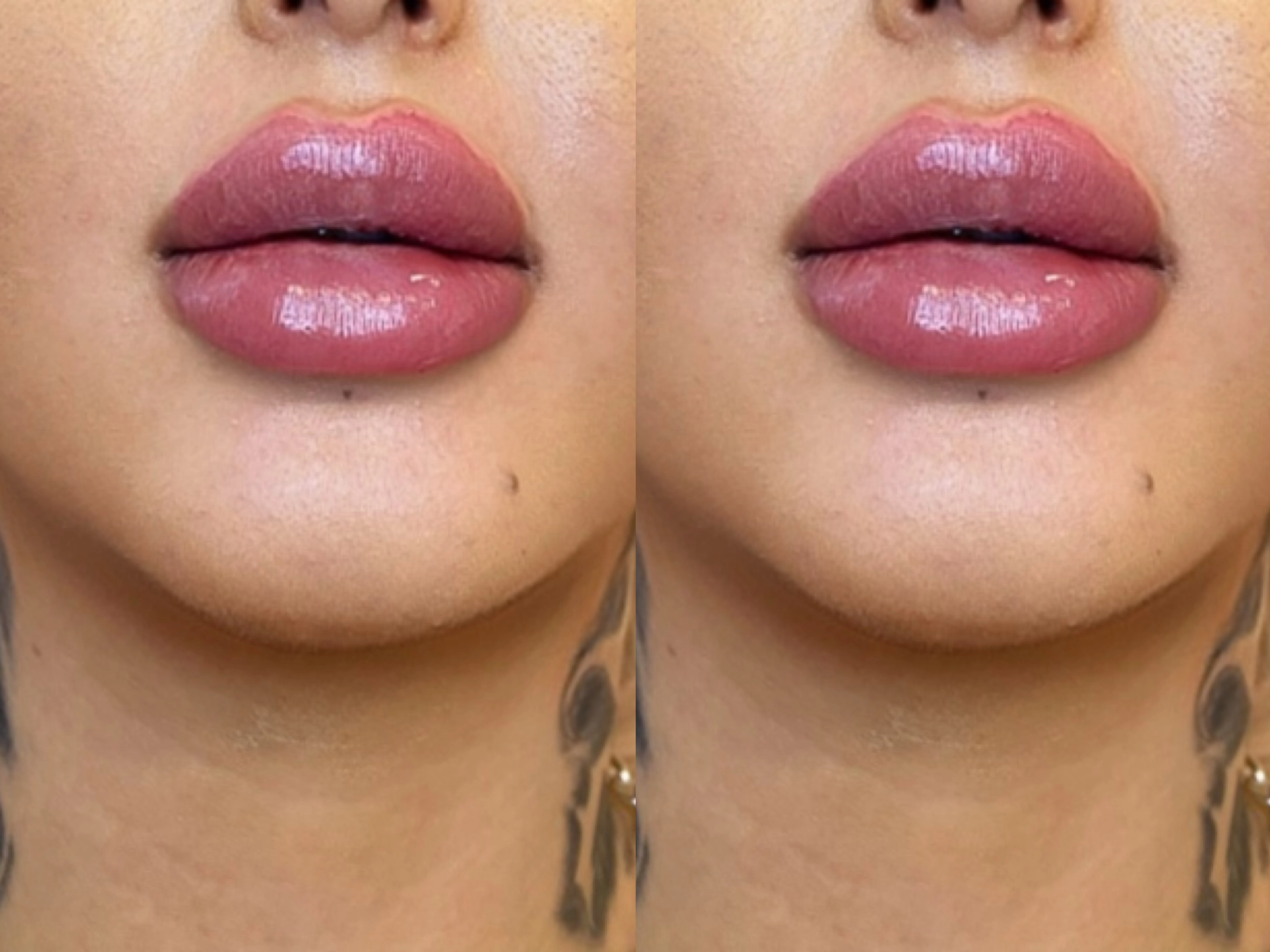 Lip Injections Medium Firm Filler