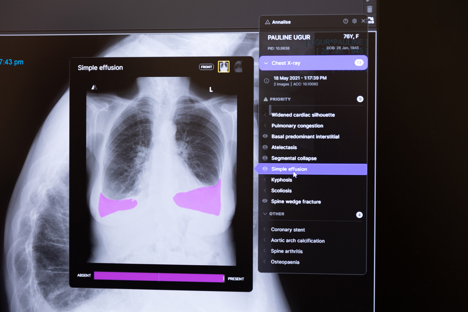 AI chest Xray solution Annalise CXR helps radiologists to make better