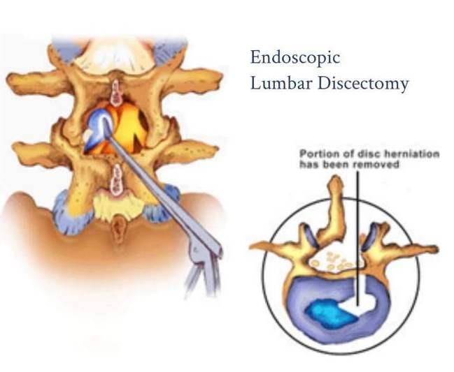 Plan Endoscopic lumbar Discectomy in India – effectively affordable!